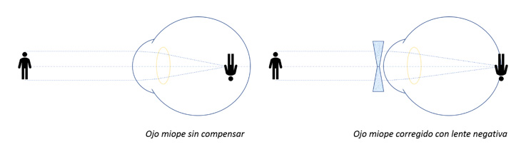 ¿Se cura la miopía? Corrección del ojo miope